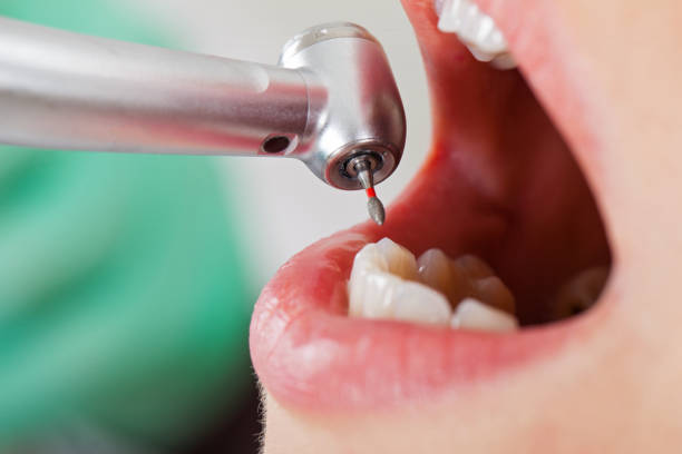 Best Emergency Root Canal Treatment in Speer, NC